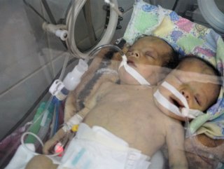 Yemenli yapışık ikizler kurtarılamadı